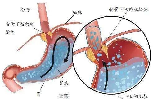 胆汁反流性胃炎都有什么症状？危害大不大？