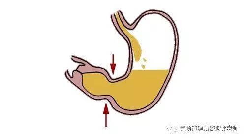 何谓胆汁反流性胃炎？