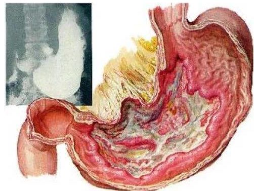 反复发作的胃溃疡被确认为癌前病变？怎么预防胃溃疡？