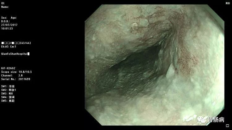 幸运！胃不舒服做个胃镜，却查出来食管早癌