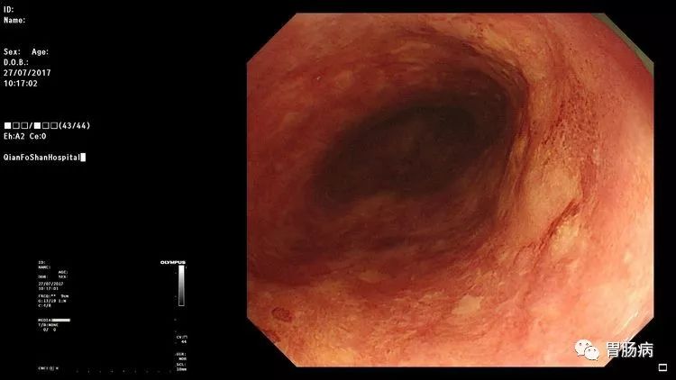 幸运！胃不舒服做个胃镜，却查出来食管早癌