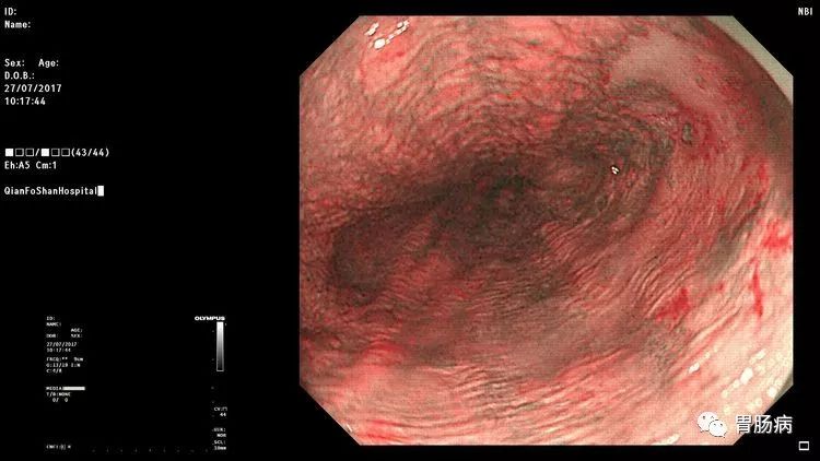 幸运！胃不舒服做个胃镜，却查出来食管早癌