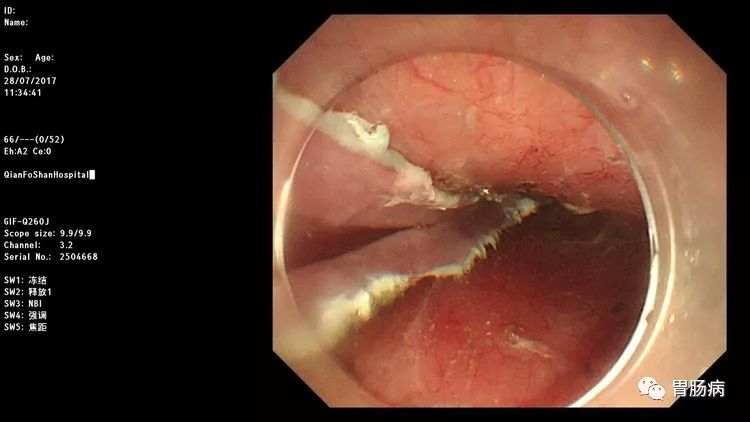 幸运！胃不舒服做个胃镜，却查出来食管早癌