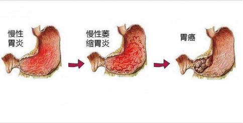 胃部隐痛，以为只是胃炎，胃镜检查却发现大问题