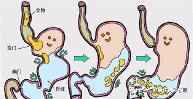 胆汁反流性胃炎：多方位侵袭你的健康，甚至引发胃癌