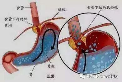 胆汁反流性胃炎，可能是最痛不欲生的胃病