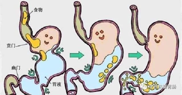 口苦、恶心、打嗝、胃胀痛、胆汁反流性胃炎该如何是好