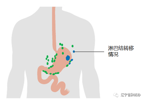 5张图片让您过目不忘胃癌分期