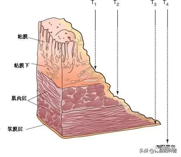 消化性溃疡病理生理图图片