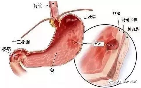 浅谈糜烂性胃炎，你对它了解多少