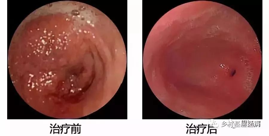 浅谈糜烂性胃炎，你对它了解多少