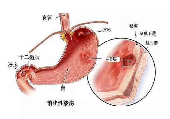 糜烂性胃炎很严重吗