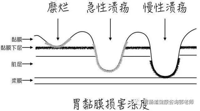 到底是糜烂性胃炎严重，还是胃溃疡严重？