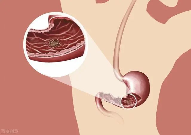 十二指肠溃疡和胃溃疡傻傻分不清？从3个方面来辨别，要谨记