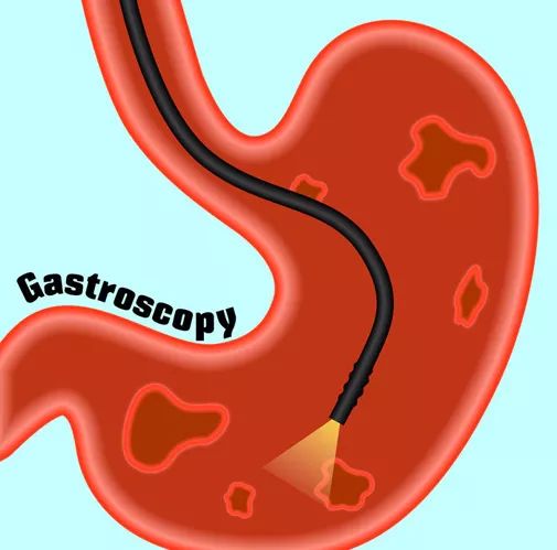 胃肠镜真的能救命，这7类高危人群该主动检查