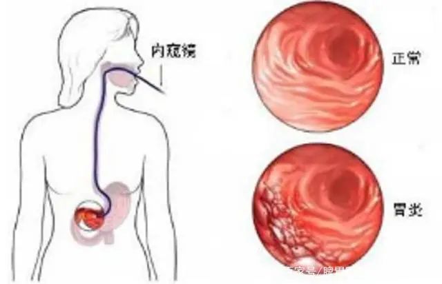 慢性非萎缩性胃炎严重吗？我们应该如何调理？