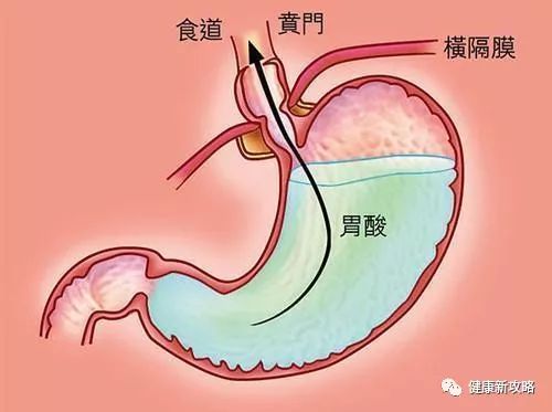 反流性食管炎痛苦难耐，不容忽视！遵守这几点，痊愈不复发