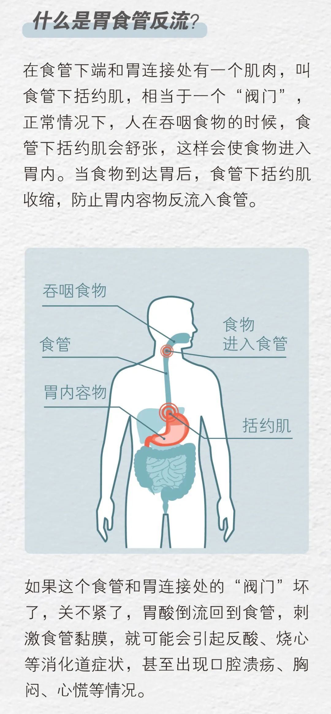 「烧心」，是怎样毁掉你的消化道的？