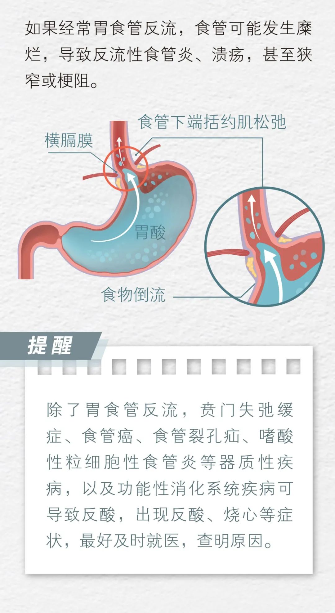 「烧心」，是怎样毁掉你的消化道的？