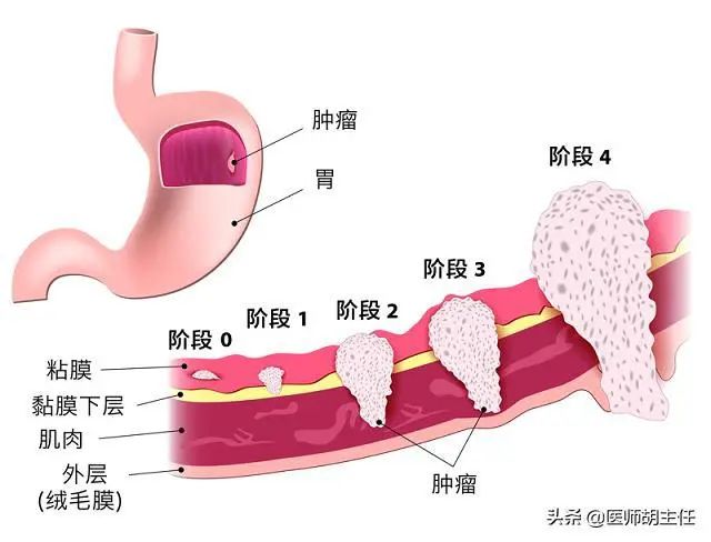 26岁男子胃癌去世！医生提醒：3类人群早做胃镜筛查，根除幽门菌