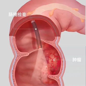 “肚大如孕”竟是便秘惹的祸