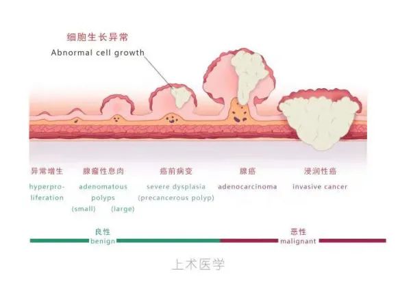 人到中年，必须做一次肠镜！肠镜最全科普奉上