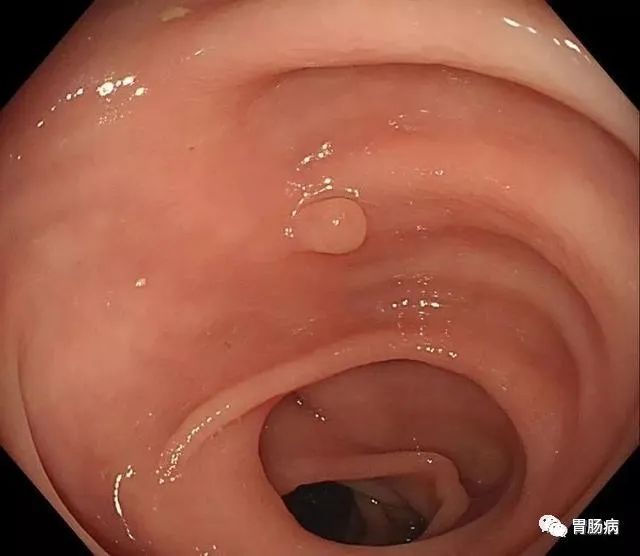 结直肠息肉