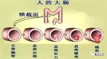 结直肠息肉