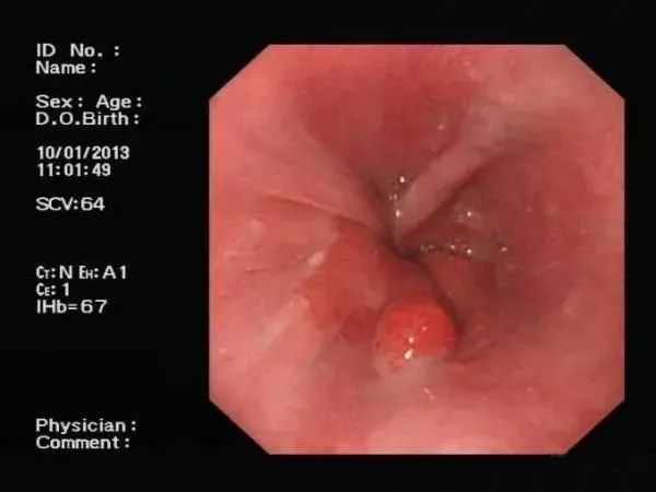 会癌变的几种胃息肉，来看看他们的真实面目！