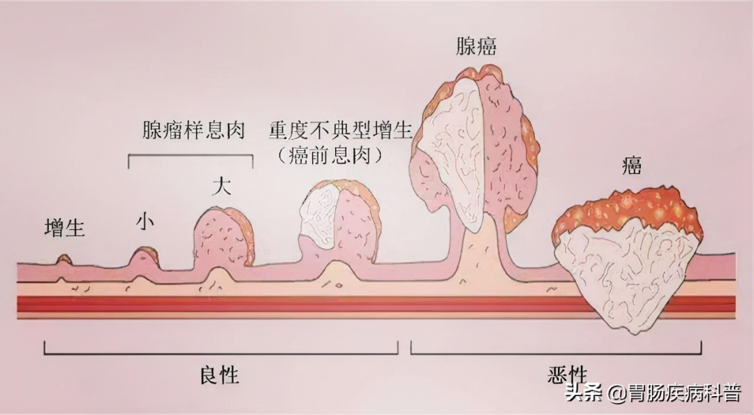 2毫米的肠息肉，6年“熬”成直肠癌！——年过40，肠镜要做，息肉要切！