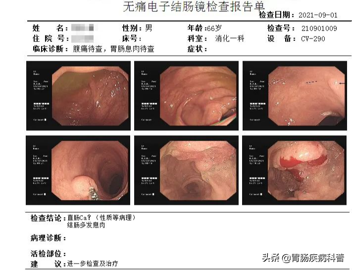 2毫米的肠息肉，6年“熬”成直肠癌！——年过40，肠镜要做，息肉要切！