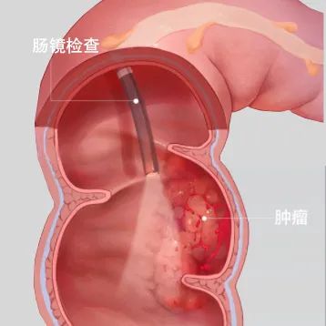 肠癌、胃癌很会“伪装”！身体出现异常症状，不要继续拖延