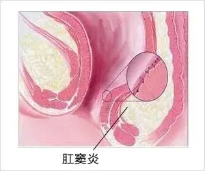 屁股痛就是上火？错！还可能是这7种肛肠问题