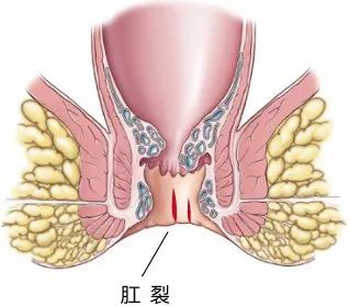 屁股痛就是上火？错！还可能是这7种肛肠问题