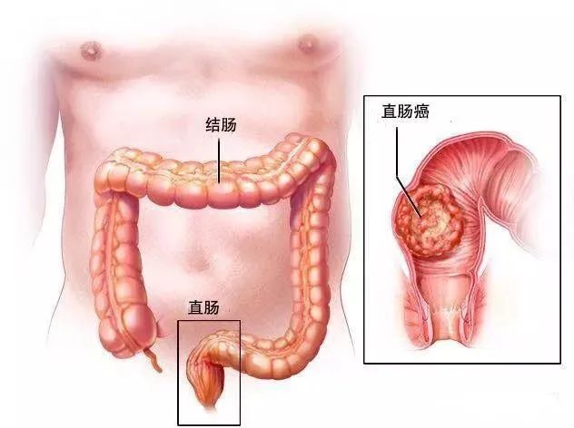 屁股痛就是上火？错！还可能是这7种肛肠问题