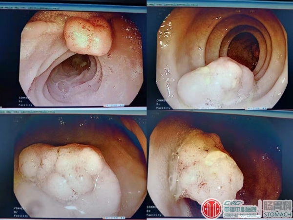 结肠直肠腺瘤图片