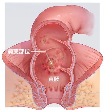 总有便意却不是便秘，很有可能是这个原因