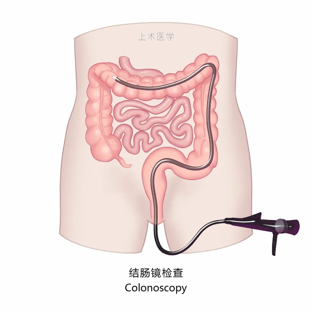 结肠镜检查能救命！出现这22种情况必须做结肠镜检查