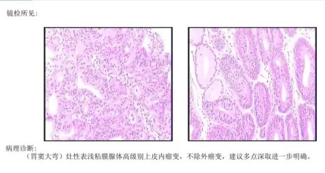 体检正常，一月后查出胃癌——体检没有胃肠镜，得了癌症都不知道