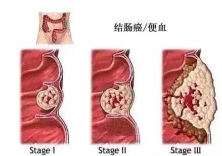 晚期肠癌到底有多可怕？34岁帅哥，患癌1年变老人，一组图刺痛全网……医生说，悲剧本可以避免的