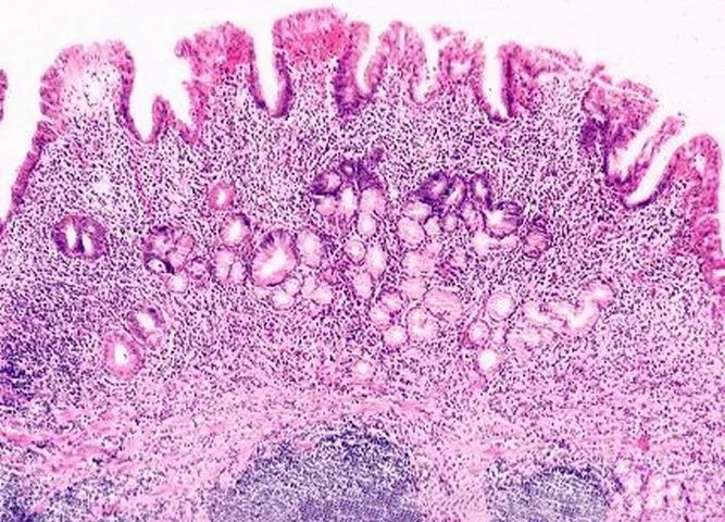 萎缩性胃炎，如何防止癌变？——听听消化科医生怎么说