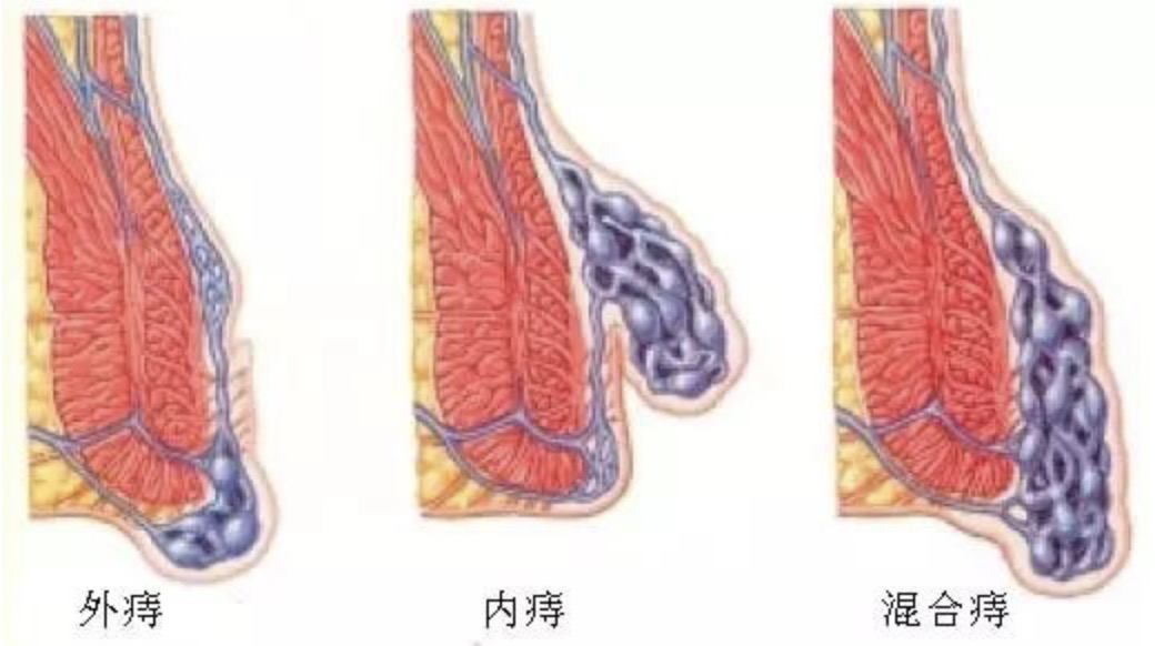 【消化病院】20岁小伙因痔疮致贫血 近乎失了全身2/3血量