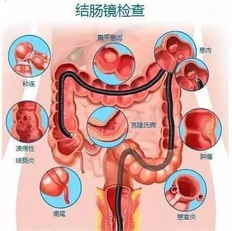 预防结直肠癌，筛查要趁早！