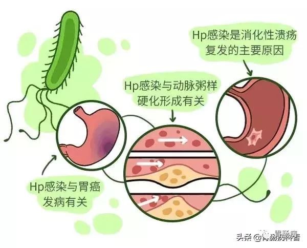 在浅表性胃炎阶段，根除幽门螺杆菌，几乎可100%预防肠型胃癌