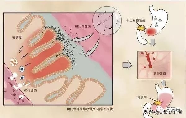 在浅表性胃炎阶段，根除幽门螺杆菌，几乎可100%预防肠型胃癌