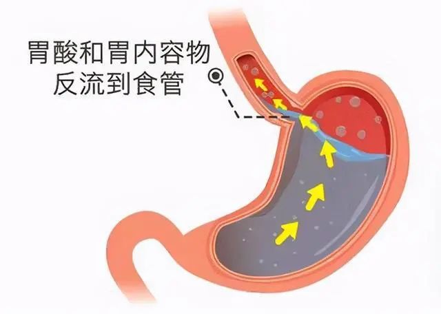 饭后反酸、烧心？或是反流性食管炎，哪些症状预示你患了反流性食管炎