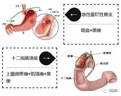 大便带血要小心！这种情况，可能是癌！