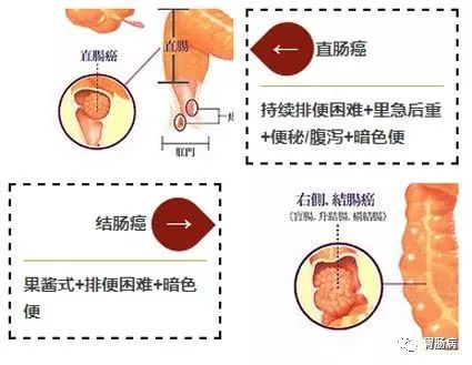 大便带血要小心！这种情况，可能是癌！