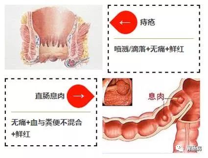 大便带血要小心！这种情况，可能是癌！