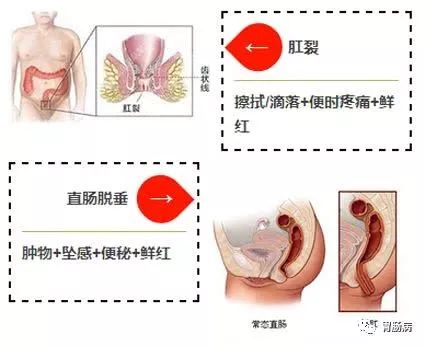 大便带血要小心！这种情况，可能是癌！